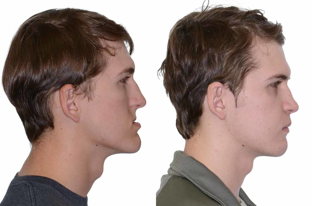 cirurgia no maxilar antes e depois
