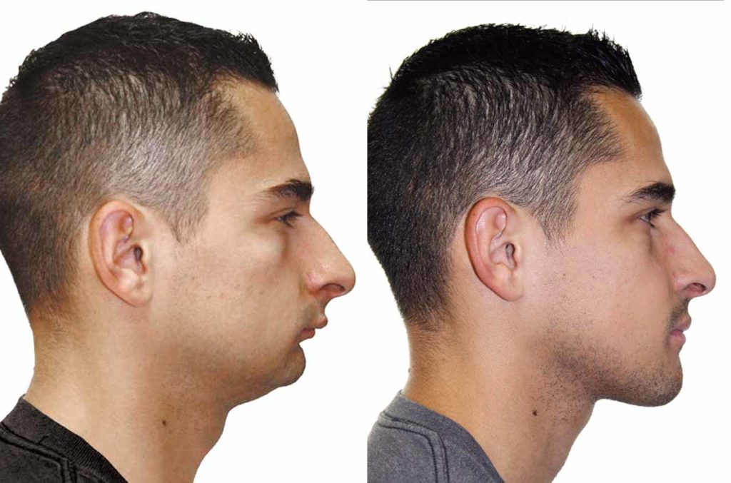 cirurgia no maxilar antes e depois 2
