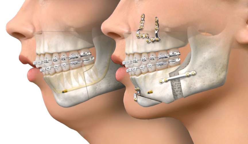 Maxilar esculpido': dentista faz alerta para perigo de exercícios