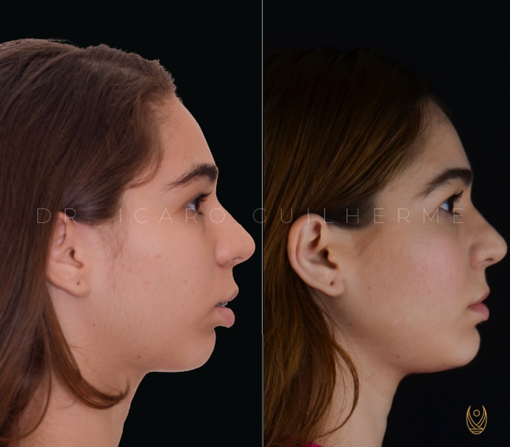 Excesso mandibular - Deficiência maxilar - Classe III - Dra