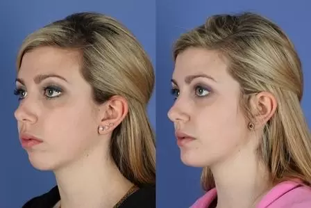 cirurgia de mentoplastia antes e depois