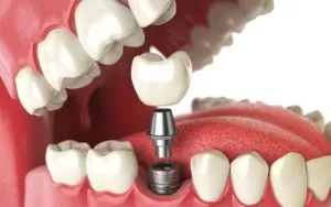 tipos de implantes dentários preço